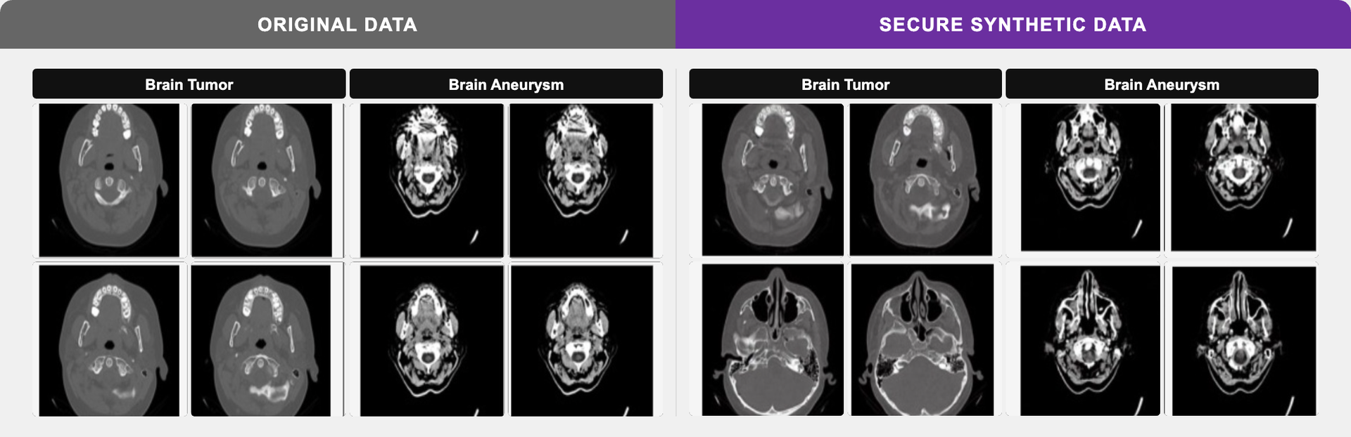 Brain Tumor & Aneurysm CT — Original vs Synthetic