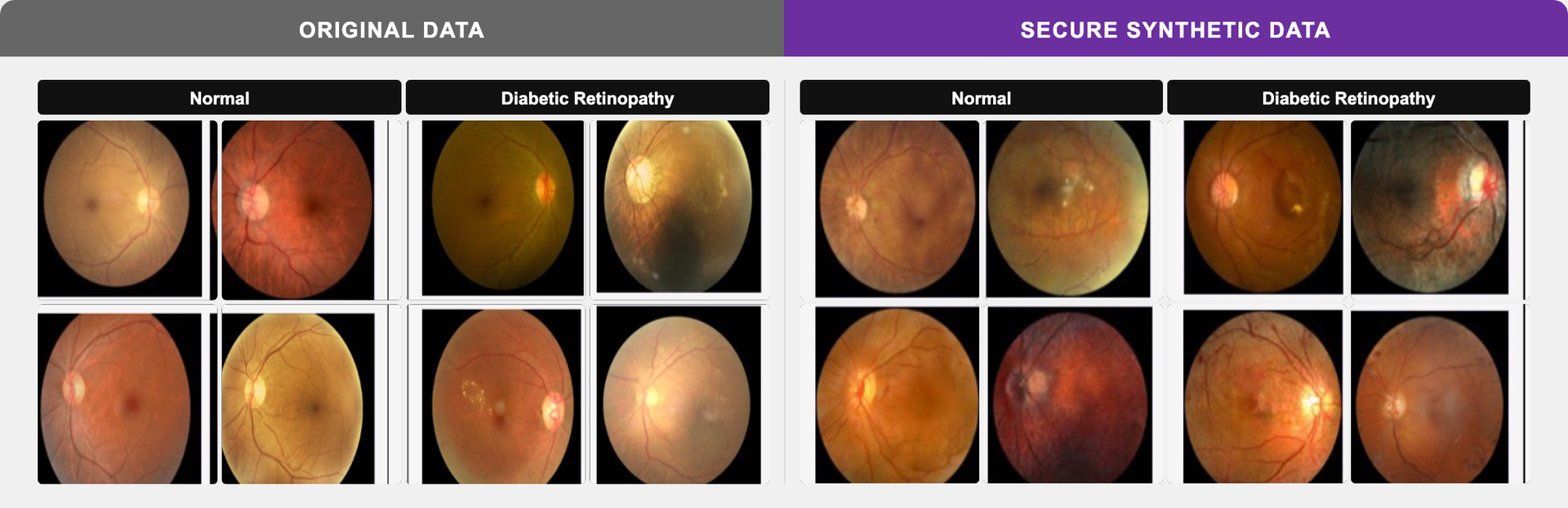 Diabetic Retinopathy — Original vs Synthetic