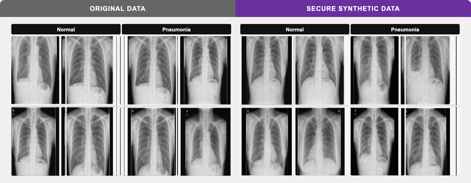 Pneumonia X-ray — Original vs Synthetic